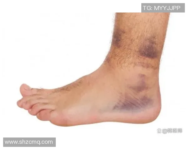足球踝骨折的预防与康复指南助你重返赛场的最佳策略